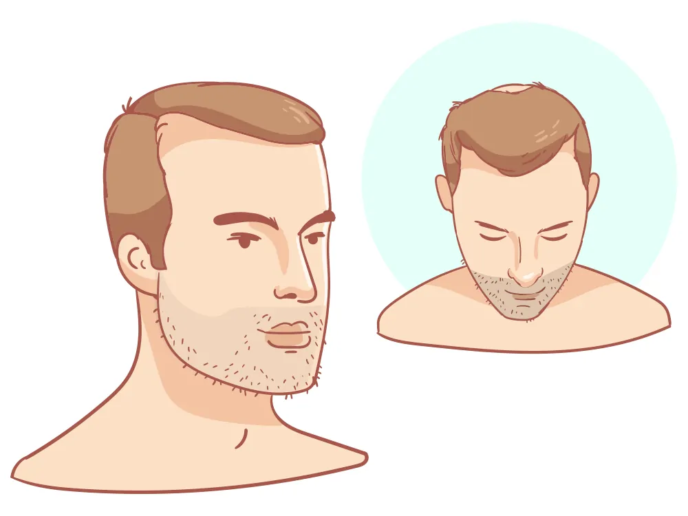 Rückläufige Haarlinie + leichte Krone