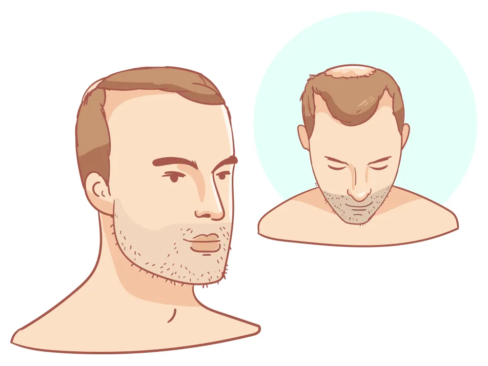 Rückläufige Haarlinie Strong + Crown
